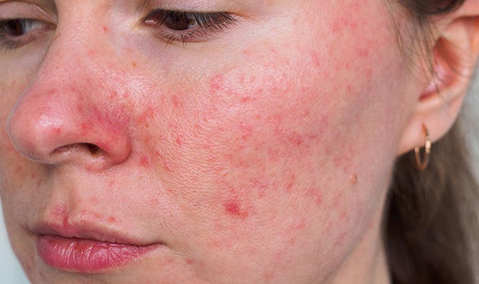 Rosacea: Everything you need to know