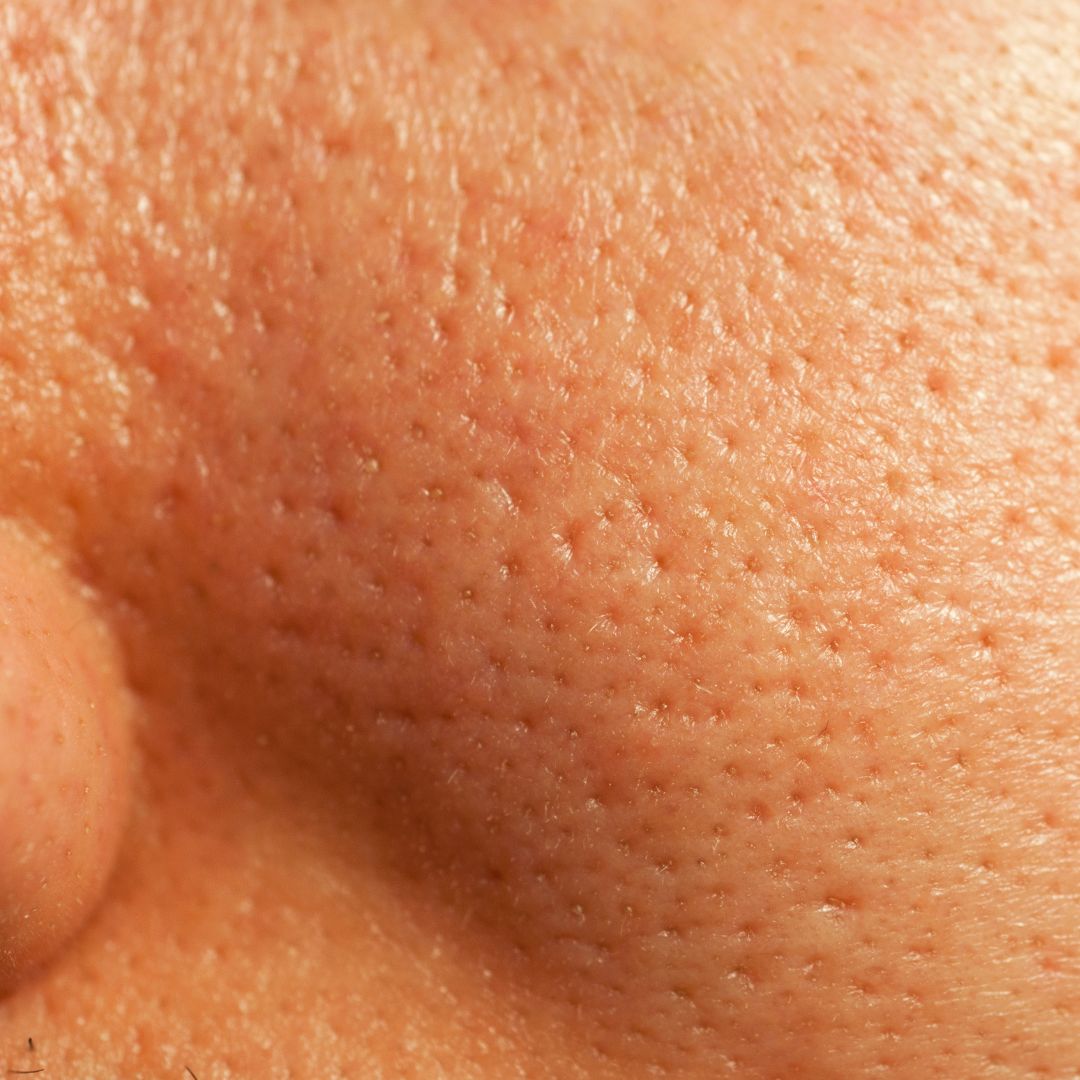 enlarged pores and techniques to minimise them naturally