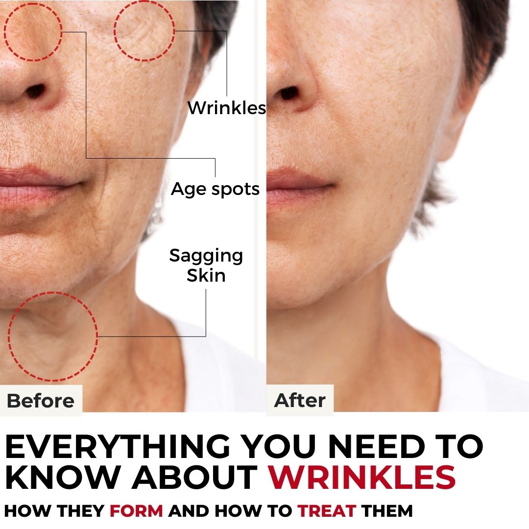 Wrinkles Examples The Science Of Wrinkles: Understanding How They Form and What To Do Ab