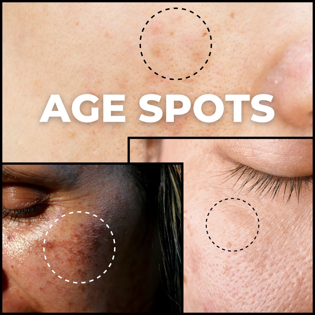 Age Spots: Causes, Symptoms, and Proven Treatments