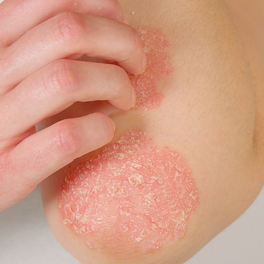 skin eczema